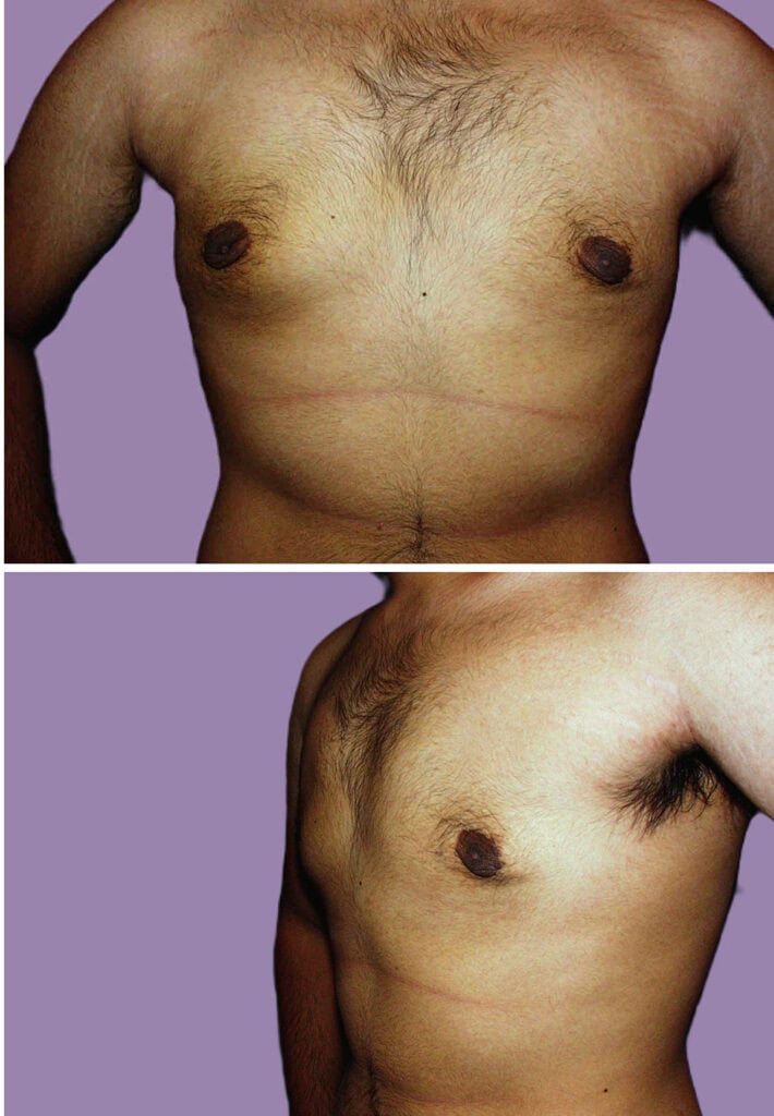 After breast