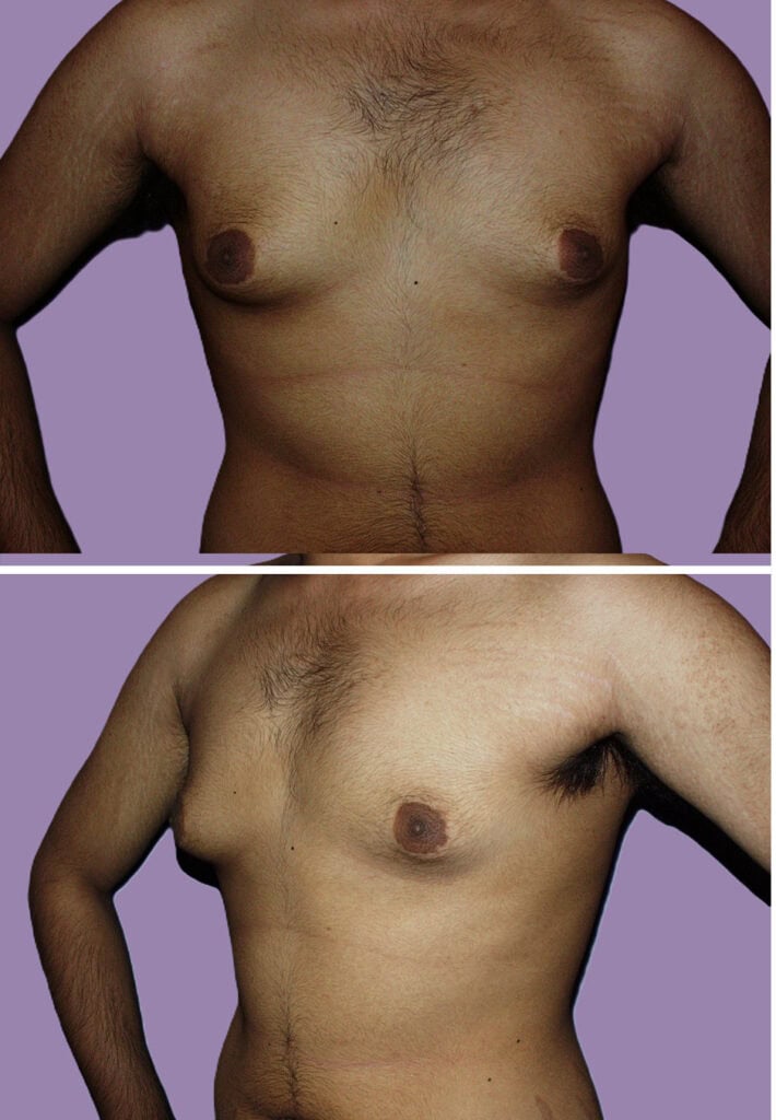 Before breast