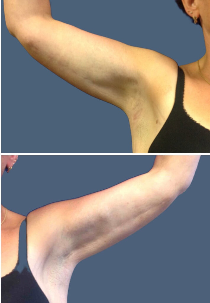 After body