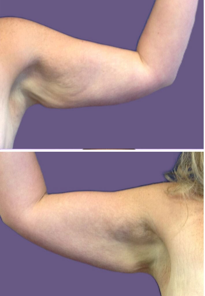 Before body
