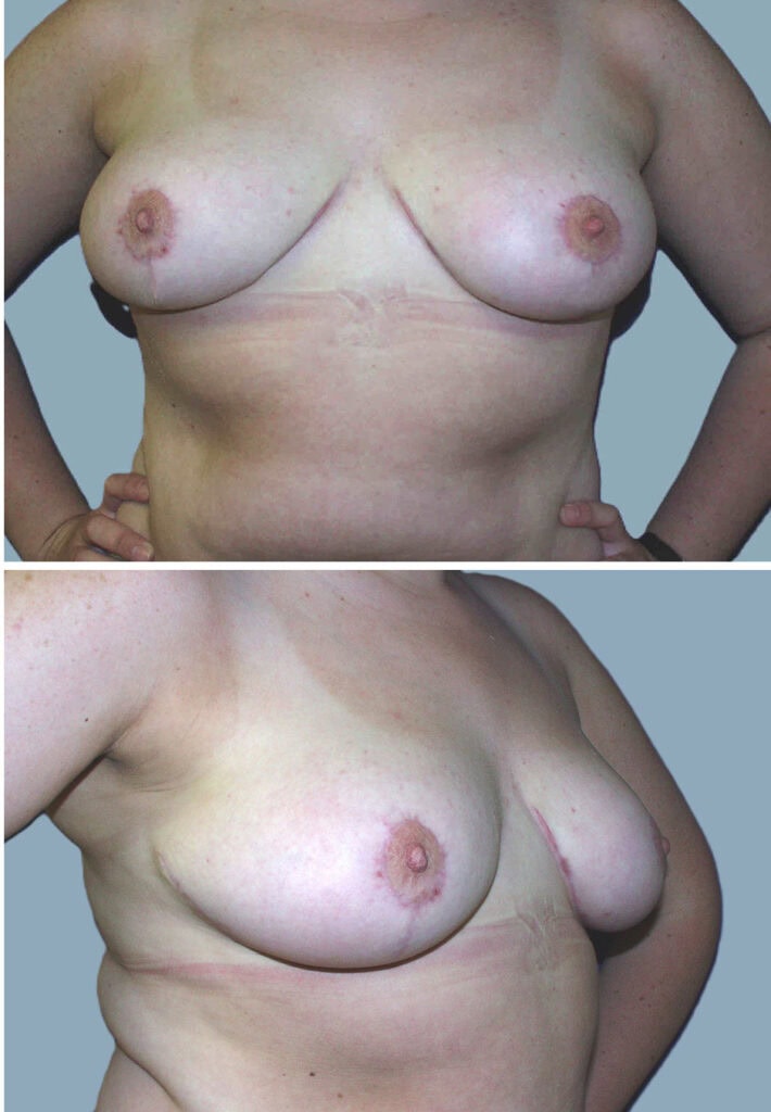 After breast reduction, DD to C cup