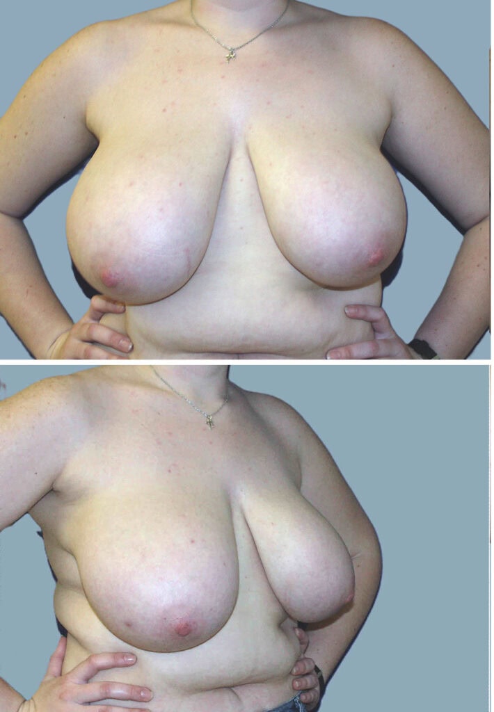 Before breast reduction, DD to C cup