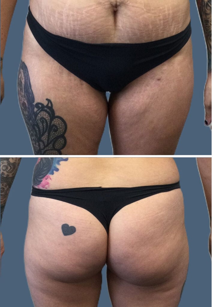 Before body