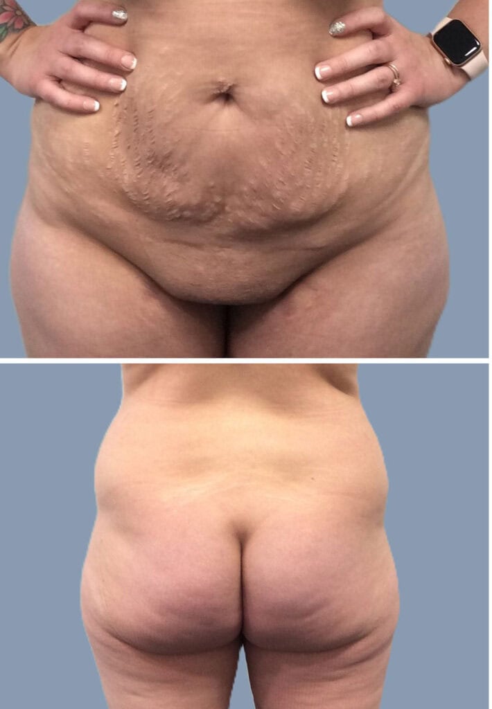 Before body