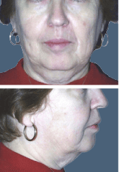 Before facial