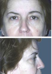 Before facial