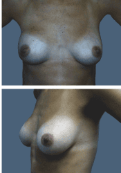 After breast augmentation, 285cc, A to B cup