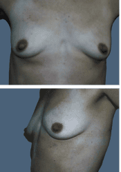 Before breast augmentation, 285cc, A to B cup