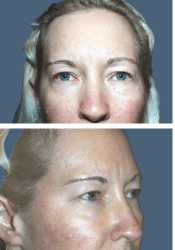 Before facial