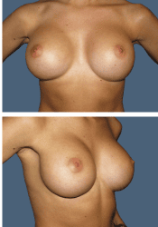 After breast augmentation, 300cc, B to C cup