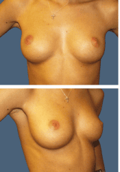 Before breast augmentation, 300cc, B to C cup