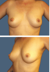 Before breast augmentation, 380cc, A to B cup