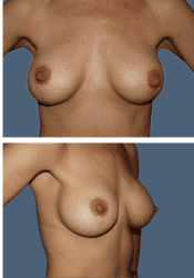 After breast lift + augmentation, 300cc