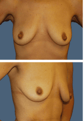 Before breast lift + augmentation, 300cc