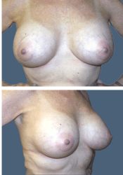After breast augmentation, 380cc, C to D cup