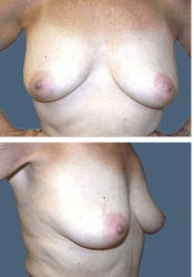 Before breast augmentation, 380cc, C to D cup