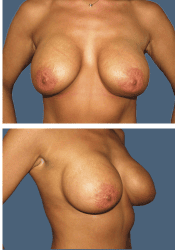 After breast augmentation, 450cc, C to D cup