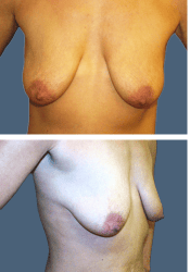Before breast augmentation, 450cc, C to D cup