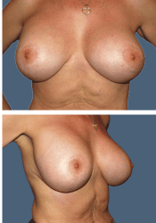 After breast, 380cc