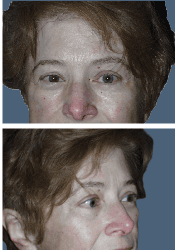 After facial