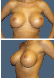 After breast augmentation, 380cc, C to DD cup