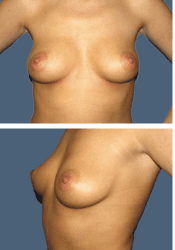 Before breast augmentation, 380cc, C to DD cup