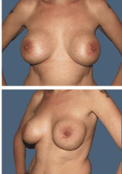 After breast augmentation, 450cc, A to DD cup