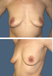 Before breast augmentation, 450cc, A to DD cup