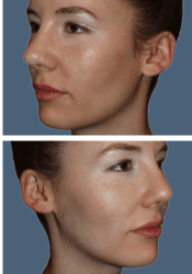 After facial
