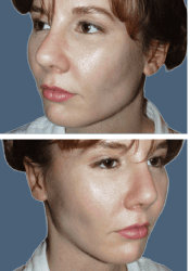 Before facial