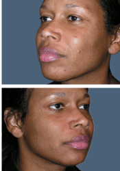 After facial