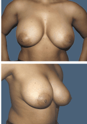After breast augmentation, 560cc, C to DD cup