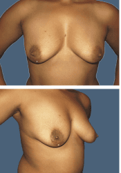 Before breast augmentation, 560cc, C to DD cup
