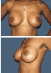 After breast augmentation, 450cc, A to DD cup