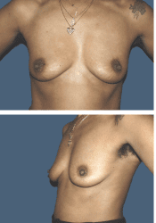 Before breast augmentation, 450cc, A to DD cup