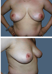 After breast reduction, DDD to D cup