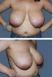 Before breast reduction, DDD to D cup