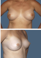 After breast augmentation, 450cc, B to C cup