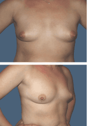 Before breast augmentation, 450cc, B to C cup