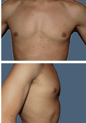 After breast