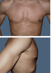 Before breast