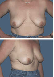 Before breast augmentation, 560cc, B to DD cup