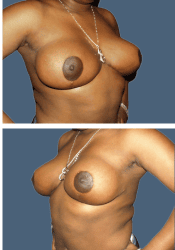 After breast reduction, F to D cup