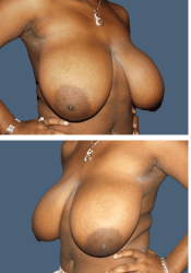Before breast reduction, F to D cup