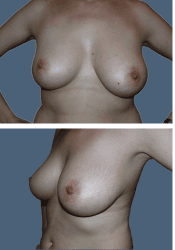Before breast