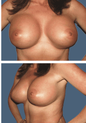 After breast augmentation, 620cc, B to DD cup