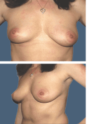 Before breast augmentation, 620cc, B to DD cup