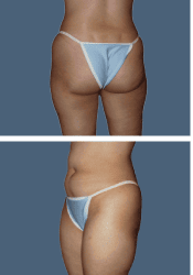 Before body