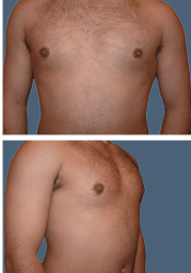 After breast