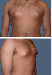 Before breast